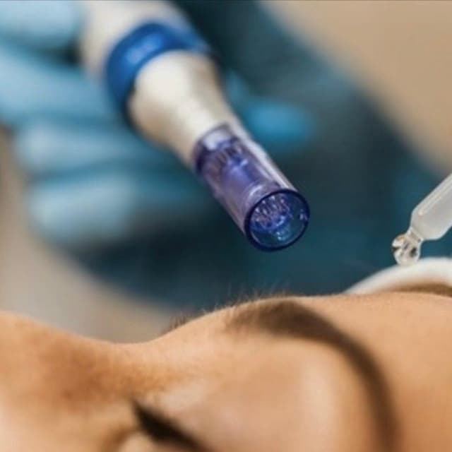 Microneedling 6 Series Face at DePianoSkin in west hollywood, CA
